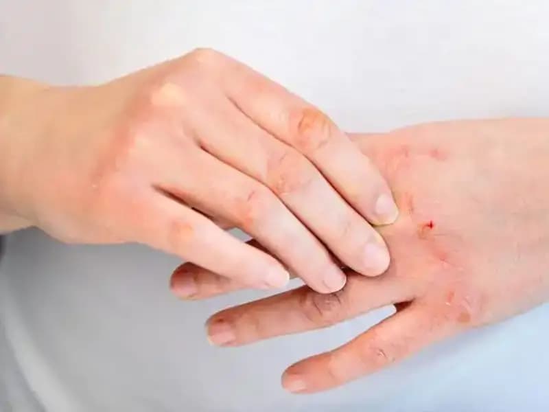 Yeterli Protein Tüketiyor Musunuz? İşte Dikkat Edilmesi Gereken 6 Belirti!