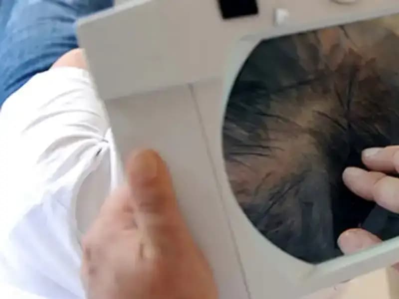 İstanbul'da Saç Ekimi Sonrası Korkunç Olay: Genç Adam Hayatını Kaybetti