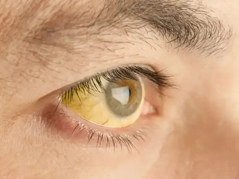 Karaciğer Sağlığınızı Tehlikeye Atan Belirtiler: Gözlerinize Dikkat Edin!